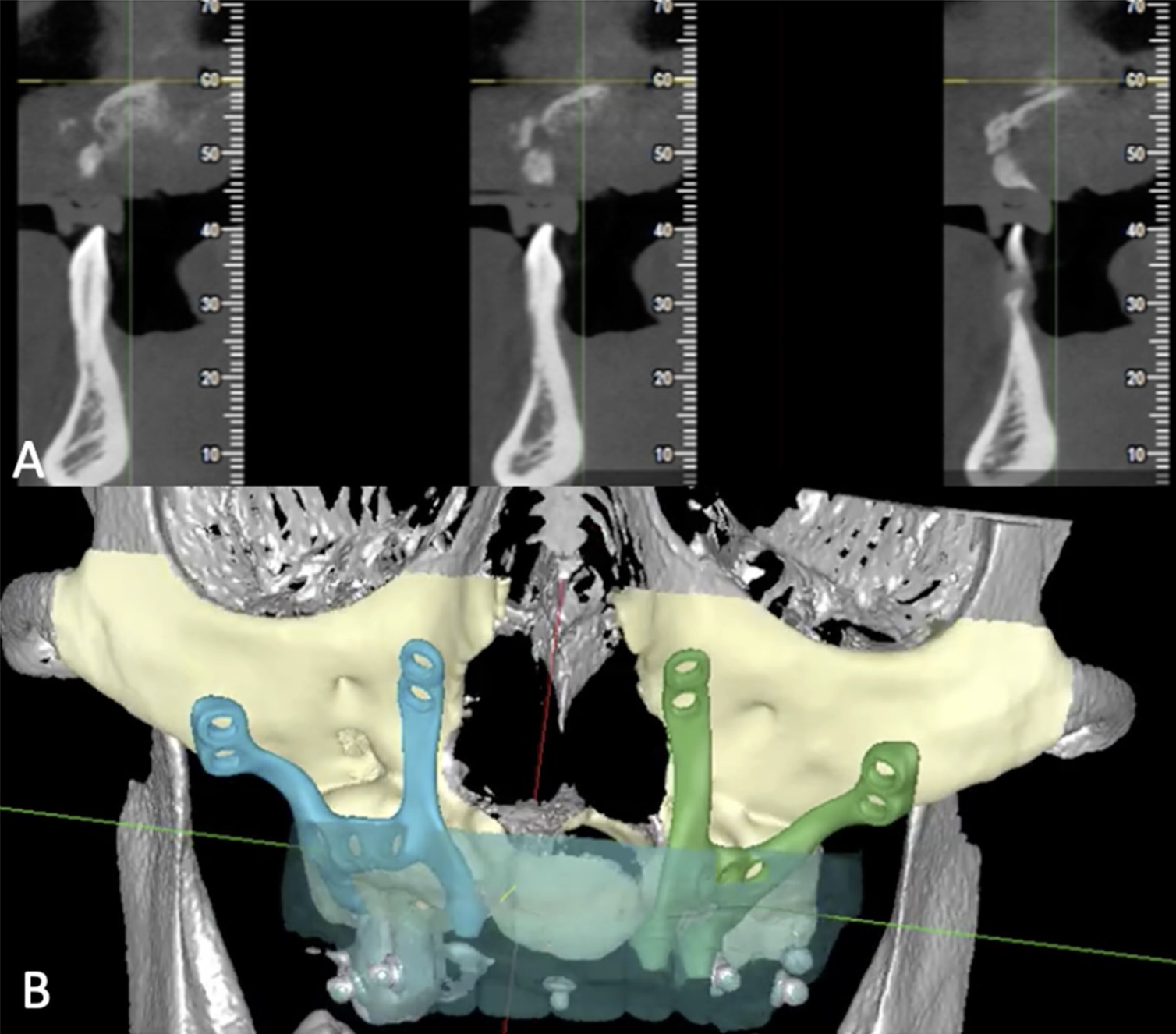 Implant-Prosthetic Rehabilitation of a Patient With EEC Syndrome