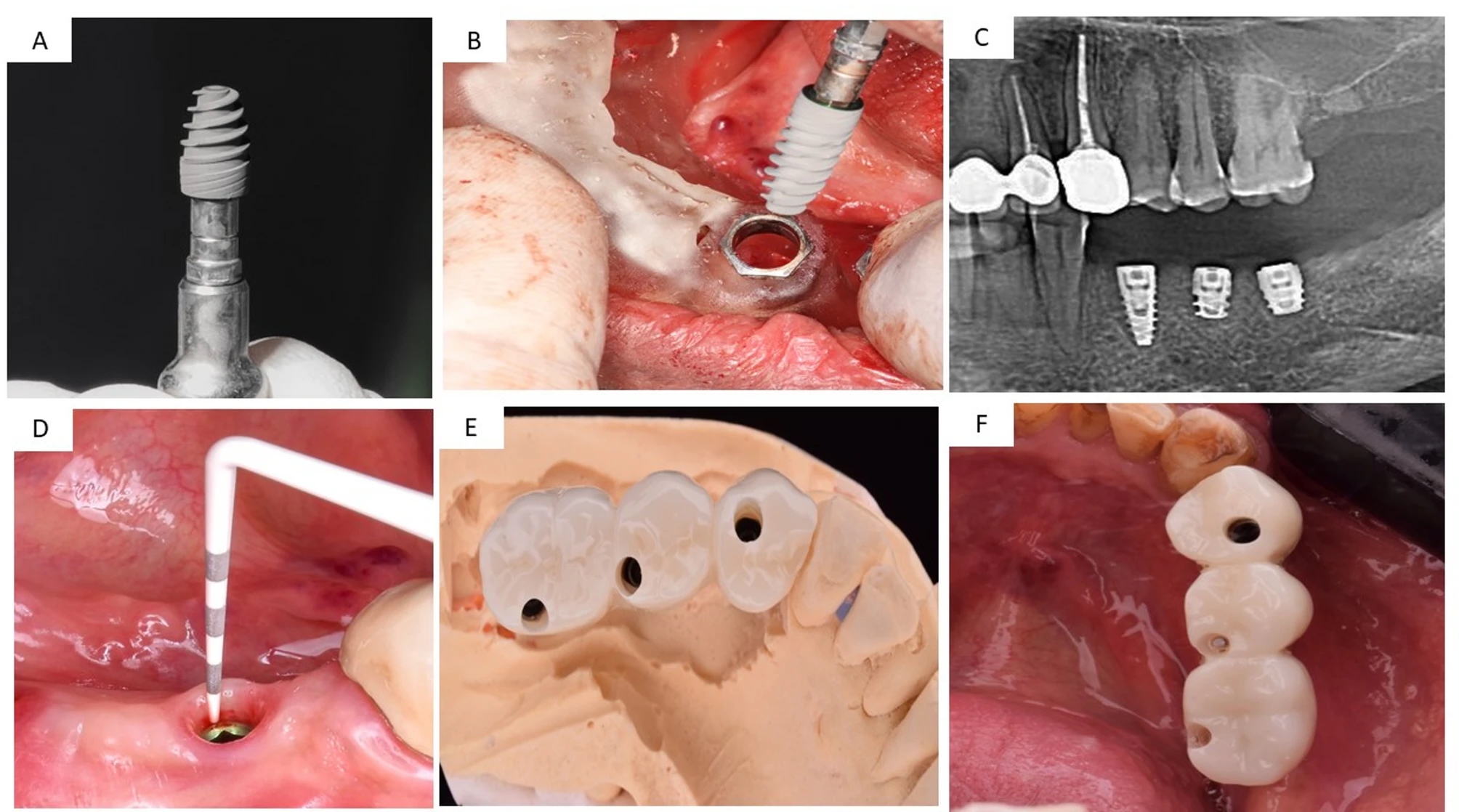 Which Works Best? Implant Survival & Patient Satisfaction in Atrophic Posterior Mandibles